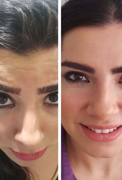 My first time getting Botox and it was so easy. The injections were quick and nearly painless. I saw the full effect after a week. I’m so happy with the glow!