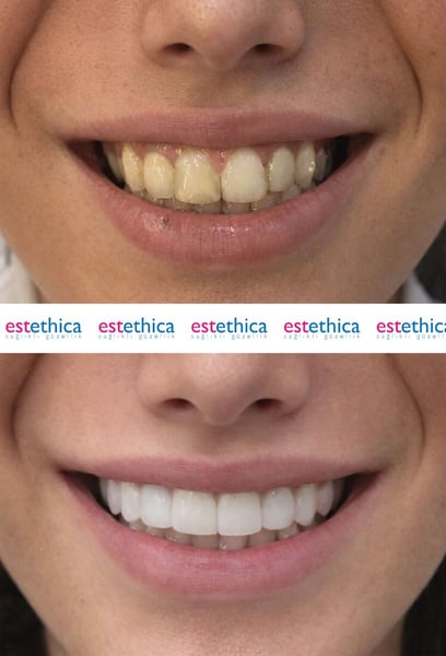 I finally found the right place for my hair transplant in Istanbul