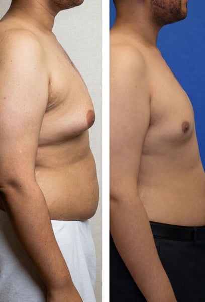 Gynecomastia wasn't just a physical issue for me; it was a social burden. This operation helped me stop hiding. I finally feel comfortable at the gym and on vacation. My quality of life has improved drastically thanks to this amazing team.