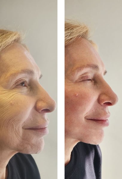 Quick, effective, and worth every cent. My face feels refreshed and balanced. It truly turned back the clock 5 years in just one appointment!