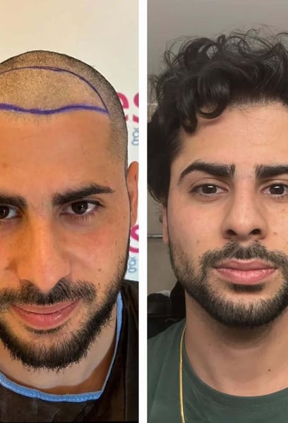 Los elegí para mi trasplante de cabello en Estambul y fue la mejor decisión que tomé.