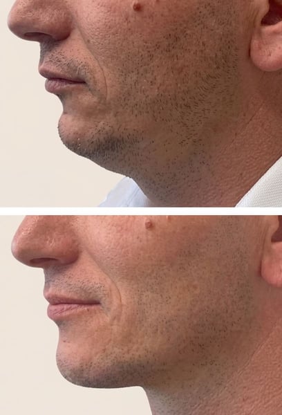 لم أدرك أبدًا مدى تأثير ذقن ضعيف على مظهري العام حتى حصلت على تحديد خط الفك. الآن، ملامحي حادة ومحددة وذكورية. لقد غير ذلك تمامًا الطريقة التي أبدو بها في الصور. أفضل قرار اتخذته على الإطلاق!