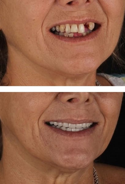 The team walked me through every step of the implant process. Their attention to detail and patient care is exceptional. I felt safe and well-informed throughout the entire journey.