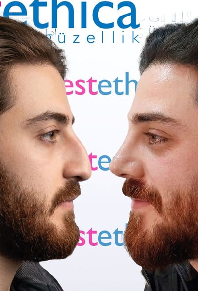 I chose them for my hair transplant in Istanbul  and it was the best decision I made.