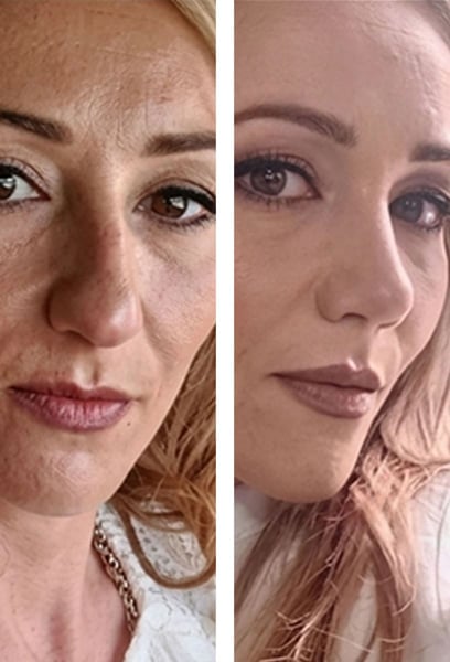 My biggest fear was looking 'pulled' or fake, but my results are incredibly natural. My friends tell me I look well-rested and glowing, without even realizing I had surgery!