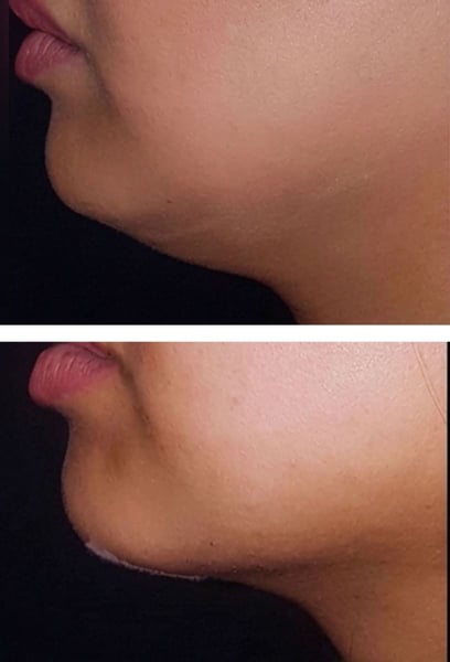 I finally have a sharp, defined jawline! The double chin that bothered me for years is gone, and my side profile looks amazing. The procedure was quick, the recovery was easy, and I look much fitter and younger. It’s the best investment I’ve ever made for my confidence!