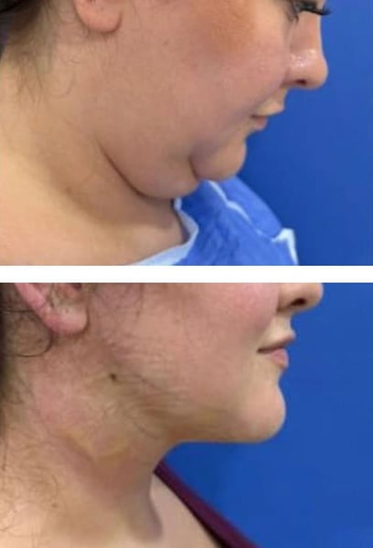 I was nervous about the recovery, but the process was surprisingly smooth. The incisions were tiny and invisible, and I was back to my routine much faster than I expected. The medical team was incredibly professional and walked me through every step. If you're considering it, don't wait!