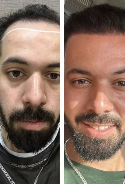 J'ai enfin trouvé le bon endroit pour ma greffe de cheveux à Istanbul.