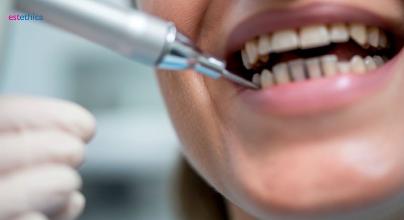 Proceso de colocación de un empaste dental