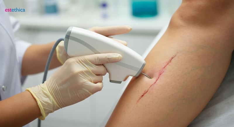 Escleroterapia y láser para venas pequeñas
