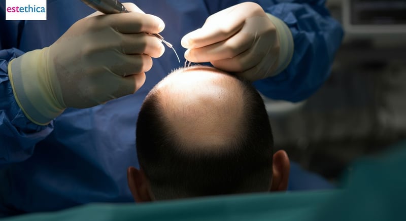 Exploring Hair Restoration Techniques