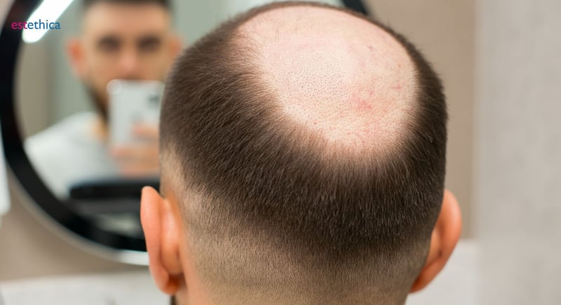 مقارنة عيادات زراعة الشعر