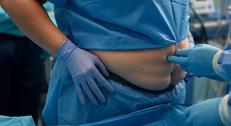 Gastric Bypass vs. Sleeve Gastrectomy comparison chart