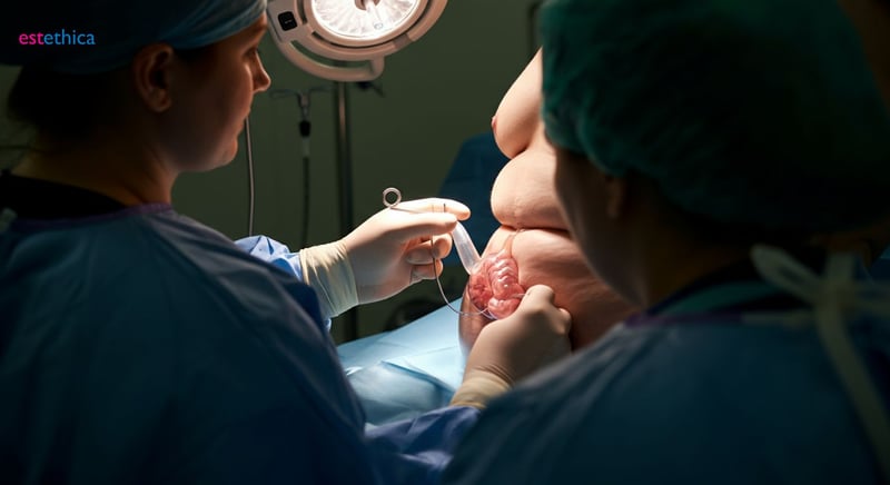 Gastric Sleeve: Operative Magenverkleinerung erklärt