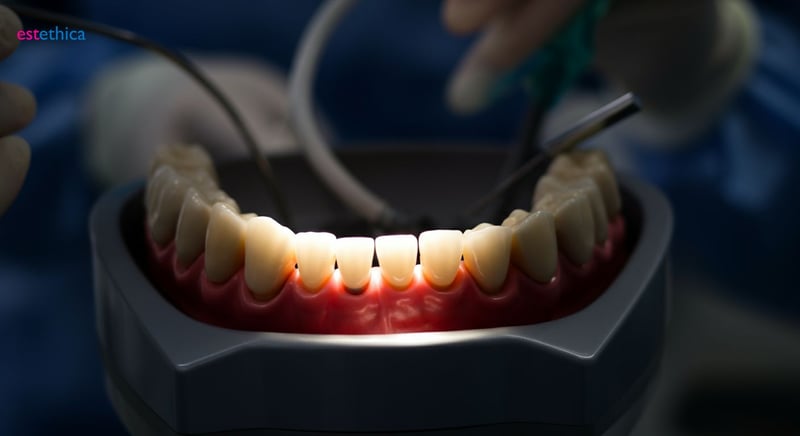 Implanturi dentare moderne pentru dinți lipsă