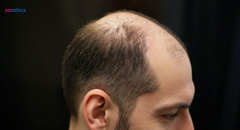 Greffe de cheveux à Paris, expert capillaire idéal