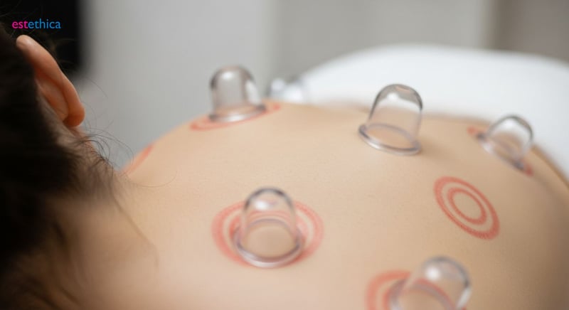 Hijama: práctica antigua de purificación para salud