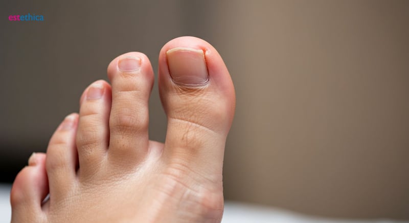 Causas y síntomas de hongos en las uñas