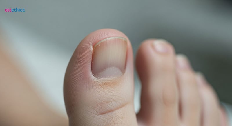 Síntomas de hongos en las uñas