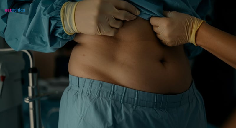 Implante de abdominales para abdomen definido
