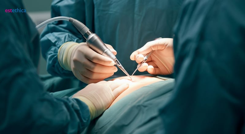 Abdominal etching safety and procedure overview