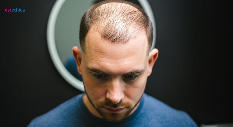 Is Hair Transplant Permanent? Exploring Long-Term Results