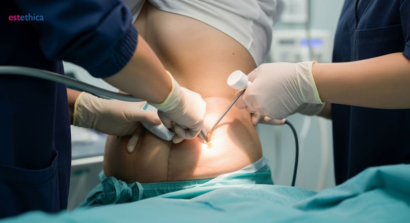 Liposuccion du ventre avant après : visualisez votre transformation