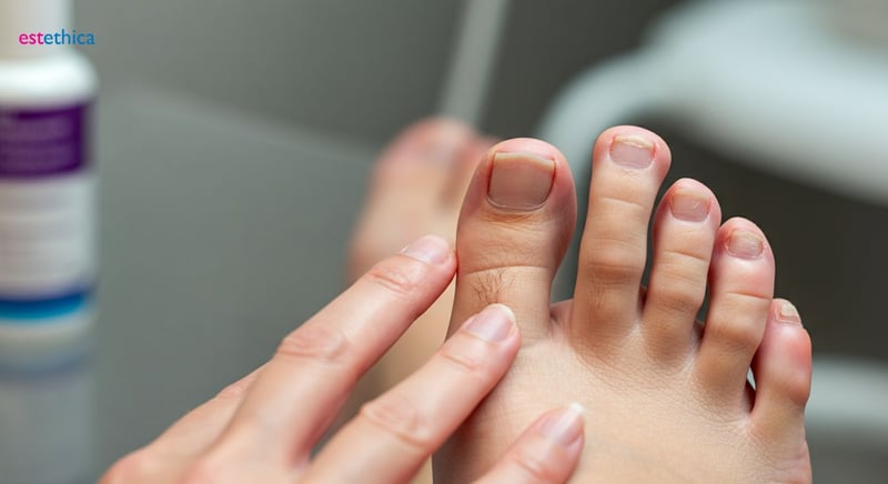 Tratamientos innovadores para onicomicosis