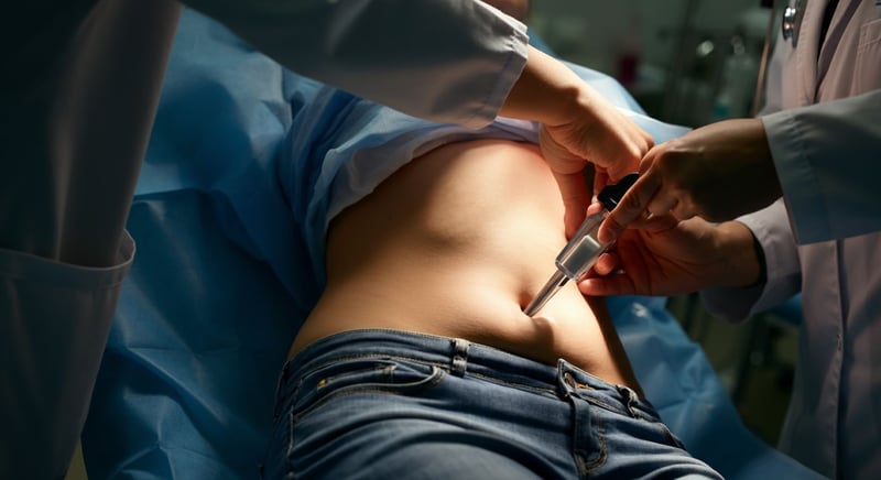 Marcación abdominal: cirugía estética para six pack