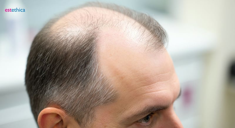 Microgreffe pour maximiser la repousse des cheveux