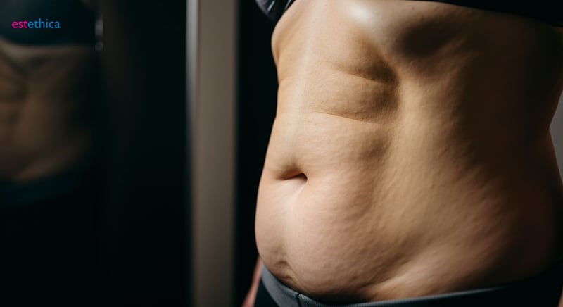 Minimalinvasive Bauchdeckenstraffung: Fortschritt für weniger Narben?