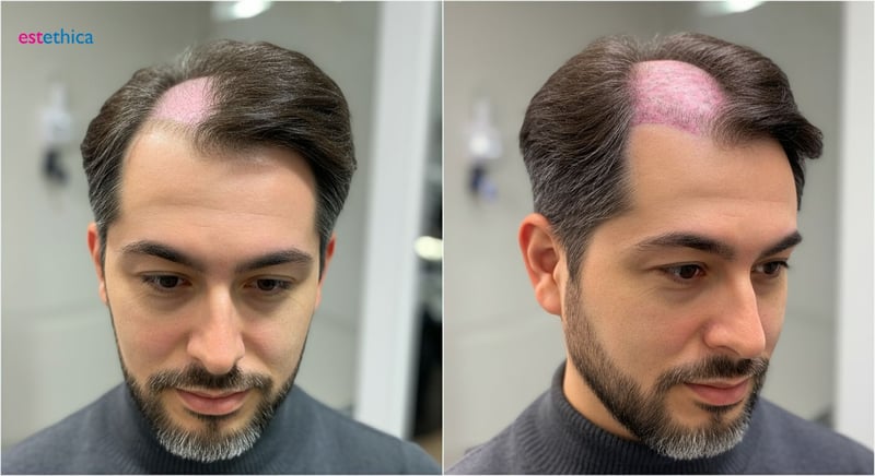 Non-surgical hair loss solutions options