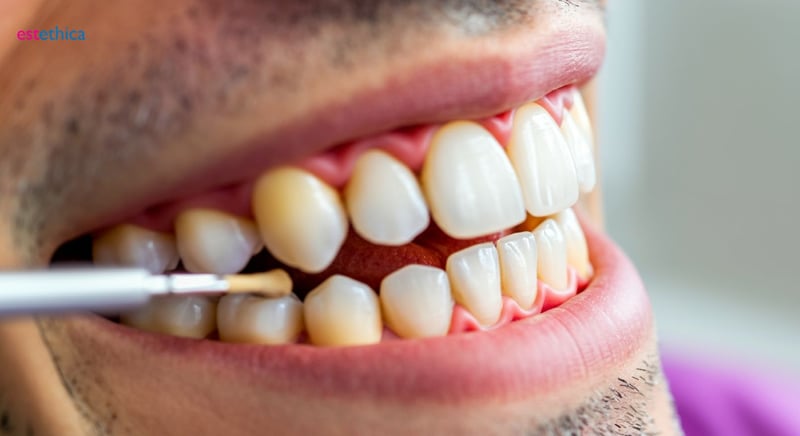 Obturación dental: restauración estética y funcional