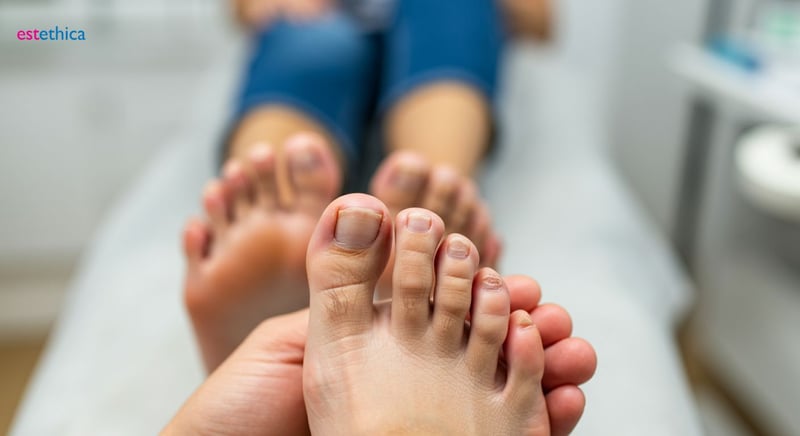 Onicomicosis bajo control: Protocolo de prevención eficaz