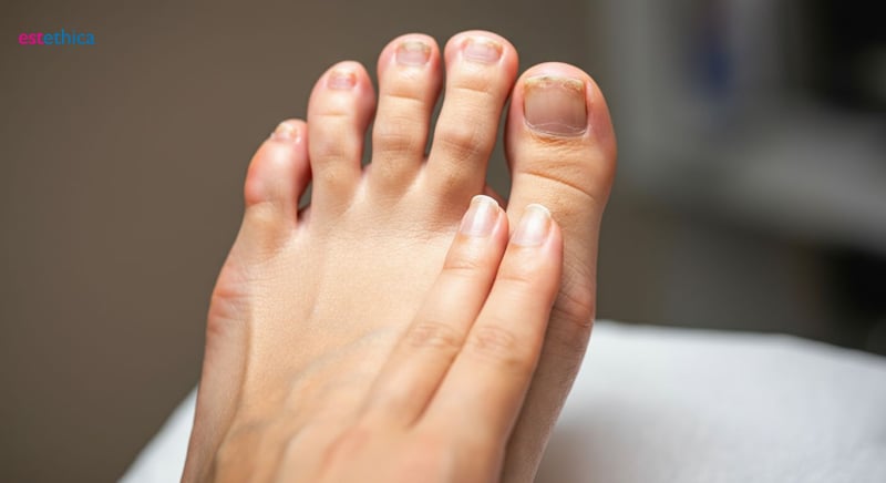 Prevención de onicomicosis en verano con cuidado dermatológico especializado