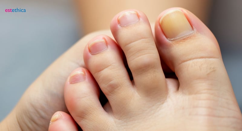 Onicomicosis y Dermatología Cosmética: Uñas Perfectas