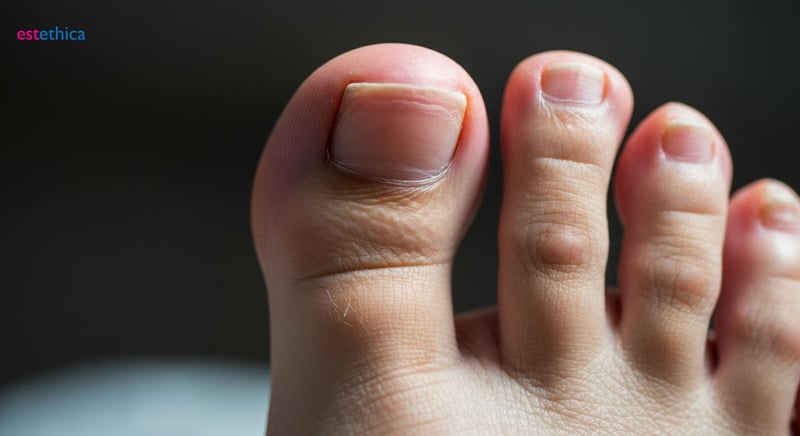 Onicomicoza: simptome și diagnostic timpuriu