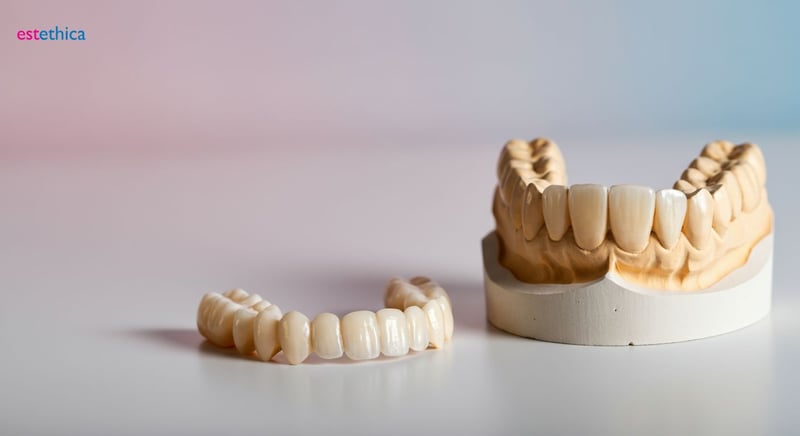 Porcelain veneers for a perfect smile