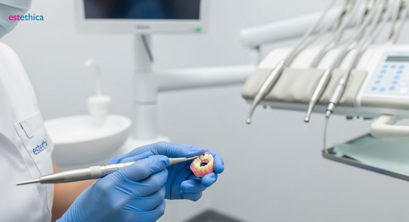 Pose de facettes dentaires : Techniques modernes et étapes clés