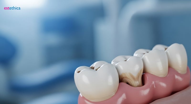 Causas y detección temprana de la recesión gingival