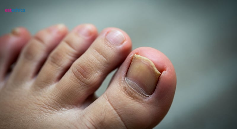 Unghie infectată cu ciupercă, aspect și simptome