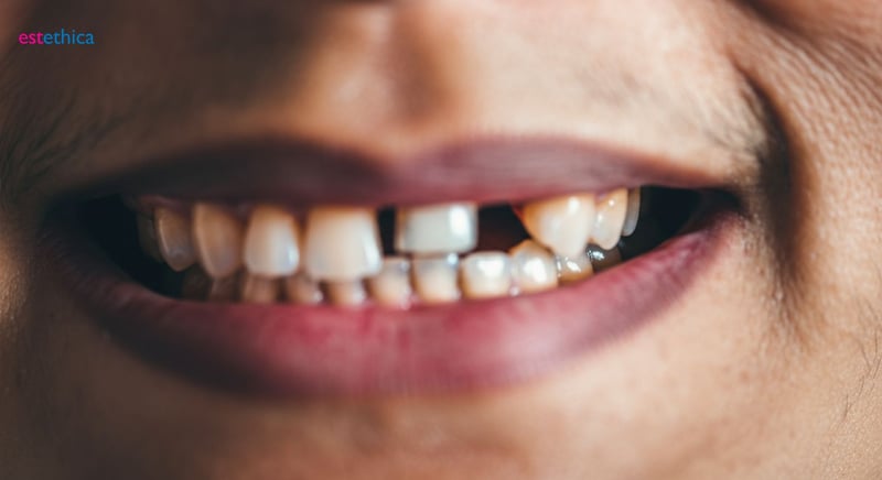 Dental implant osseointegration process illustration