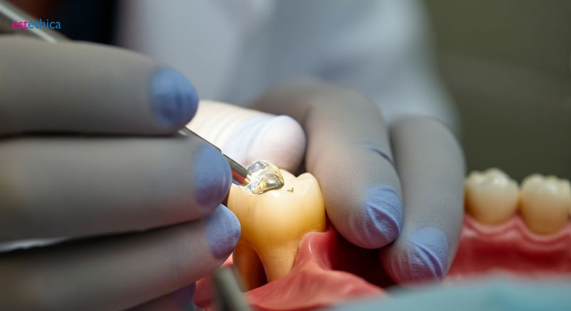 Tipos de empastes dentales: elige el material adecuado
