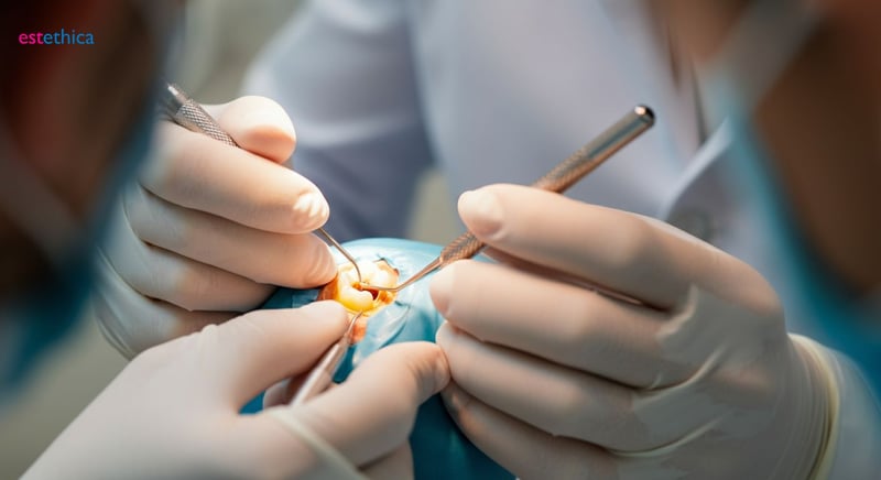 Tipos de rellenos dentales: mejor material para salud bucodental