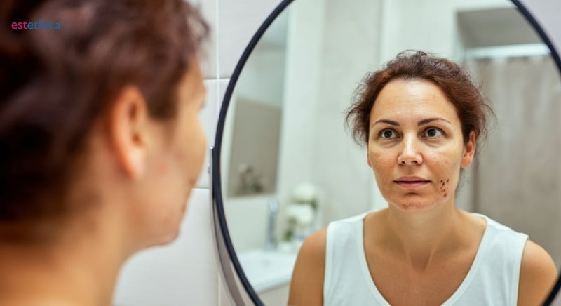 Tratamientos caseros para manchas en la piel