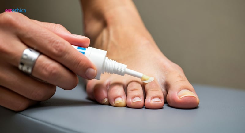Tratamientos para onicomicosis: remedios caseros y opciones médicas