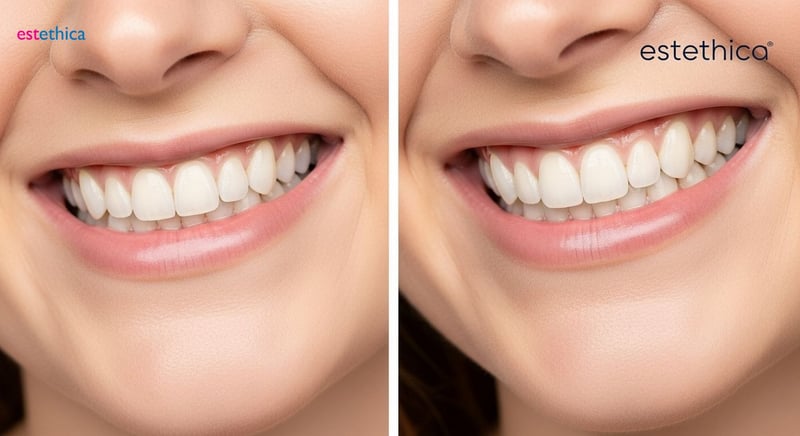 Veneers for crooked teeth achieving straight smiles artistically