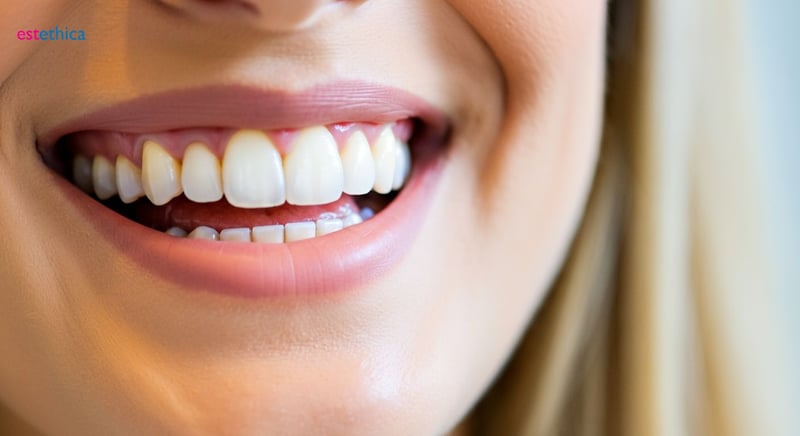 Veneers ohne Beschleifen möglich