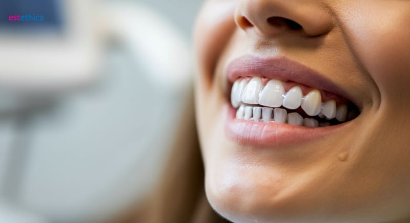 Zahnveneers Vorher-Nachher Verwandlung
