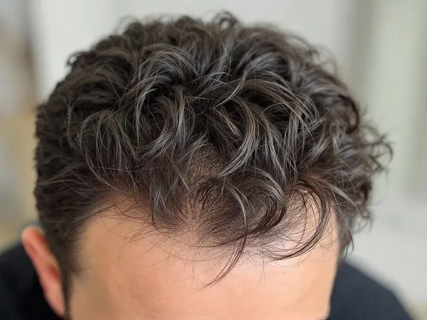 Las mejores clínicas para trasplante de pelo en España